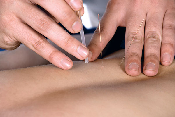 acupuncture as physiotherapy